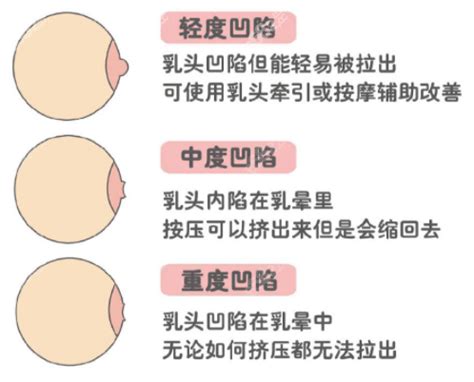 乳頭周圍長毛|乳頭內凹、長毛正常嗎？ 8類「乳頭形狀」你的是哪種 